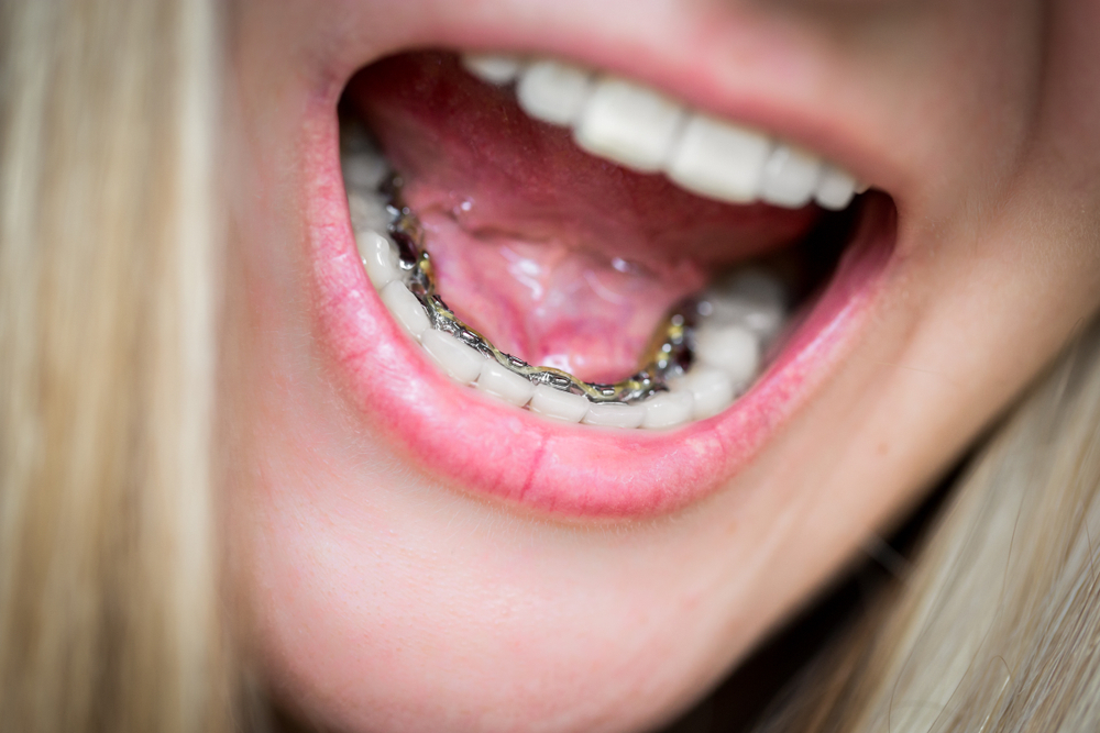 Çapraşık Dişler ve Görünmeyen Diş Telleri