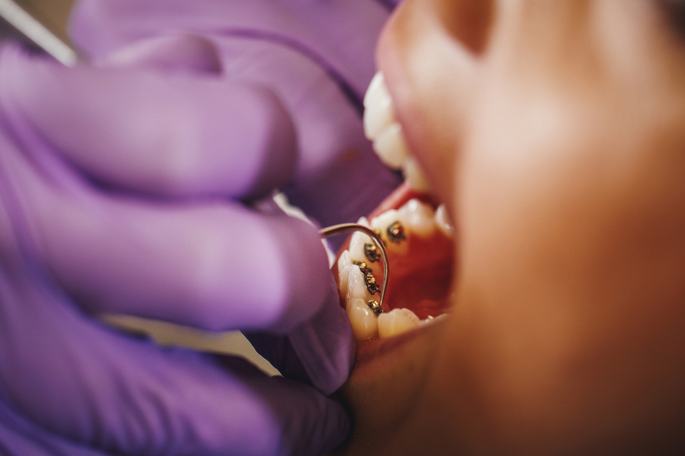Lingual Ortodonti Fiyatları