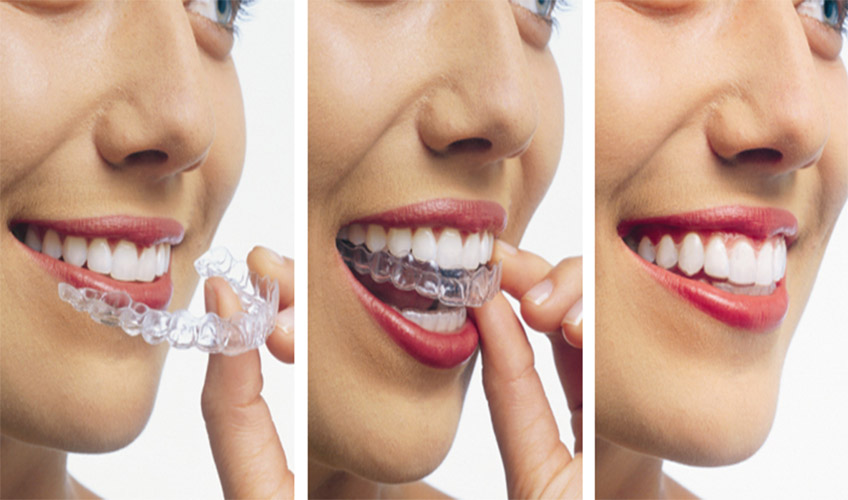 Invisalign