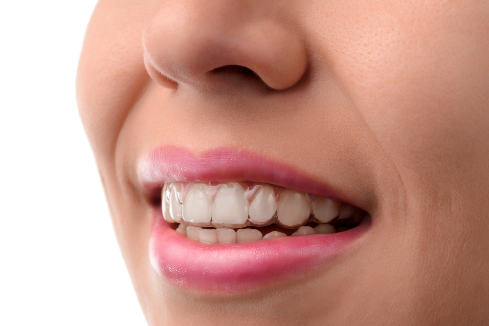 “Görünmez Diş Teli’’ İle Tedavi Aşamaları Nelerdir?
