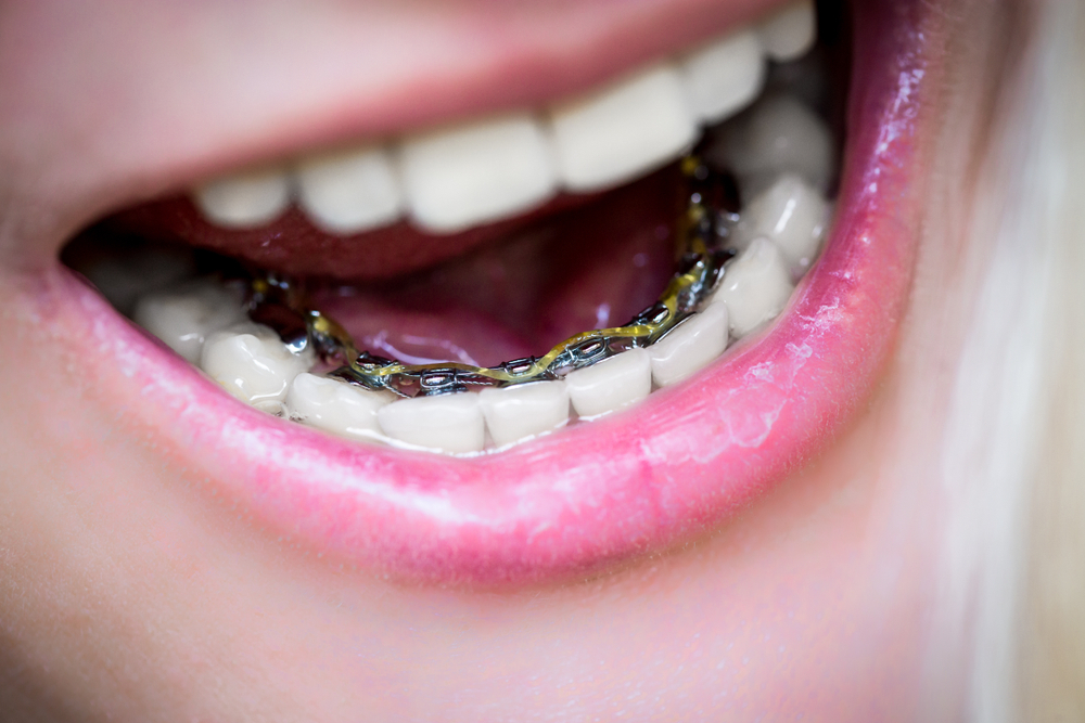 Estetik Gülüşlerin Arkasındaki Sır: Görünmeyen Diş Telleri