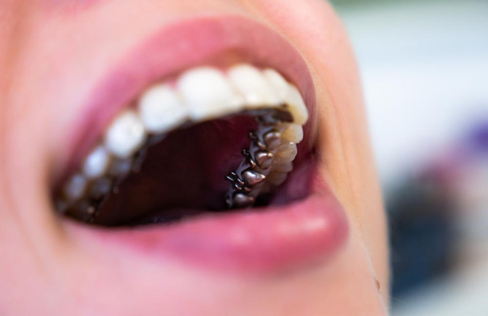 Gizli Diş Teli Tedavisi Ayrı Bir Uzmanlık Gerektiriyor