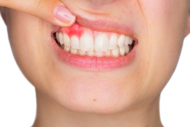 Lingual Ortodonti ve Diş Eti Problemleri