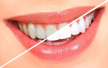 Lingual Teknik ve Diş Beyazlatma