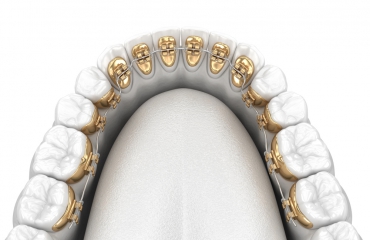 Ortodonti Hakkında Genel Bilgiler