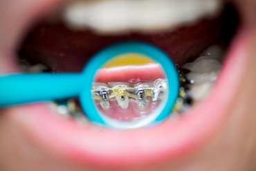 Erişkinlerde Ortodonti Ne Zaman Uygulanabilir?