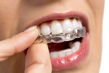 Görünmeyen Diş Teli: Ortodontik Tedaviden Beklentini Değiştir!
