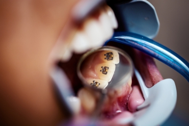 Lingual Ortodonti ile ilgili Sık Sorulan Sorular