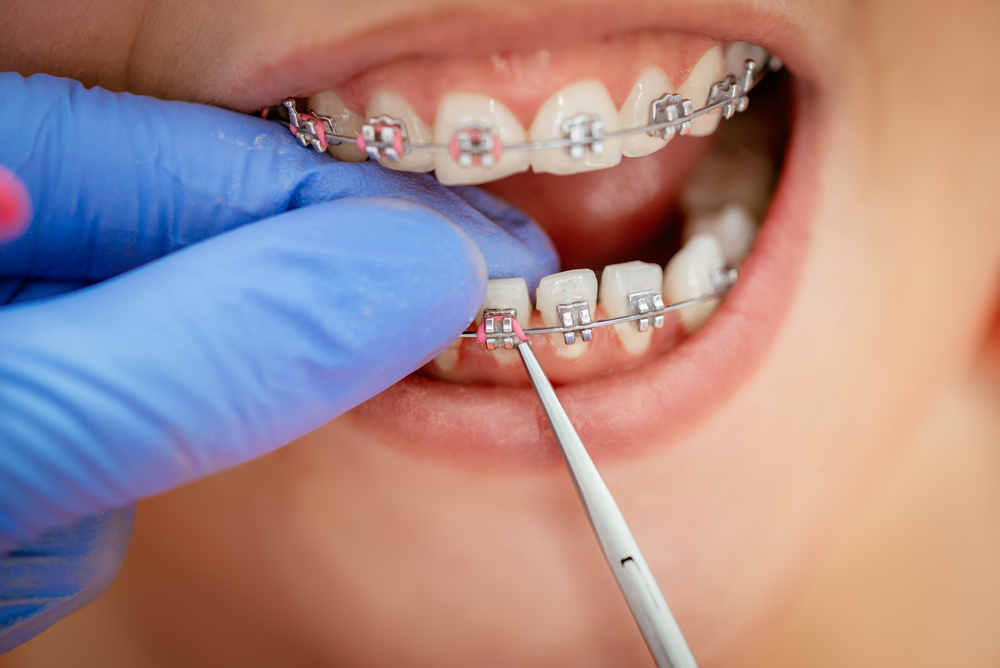 20 Yaş Dişleri ve Ortodontik Tedavi