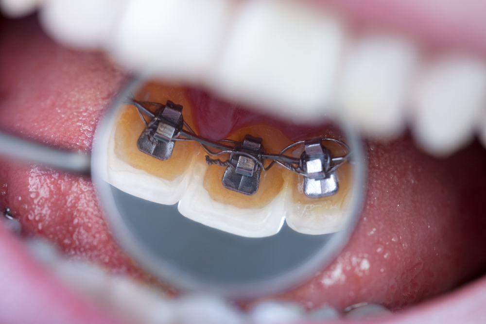 Lingual Ortodonti'de Mini Vidalar