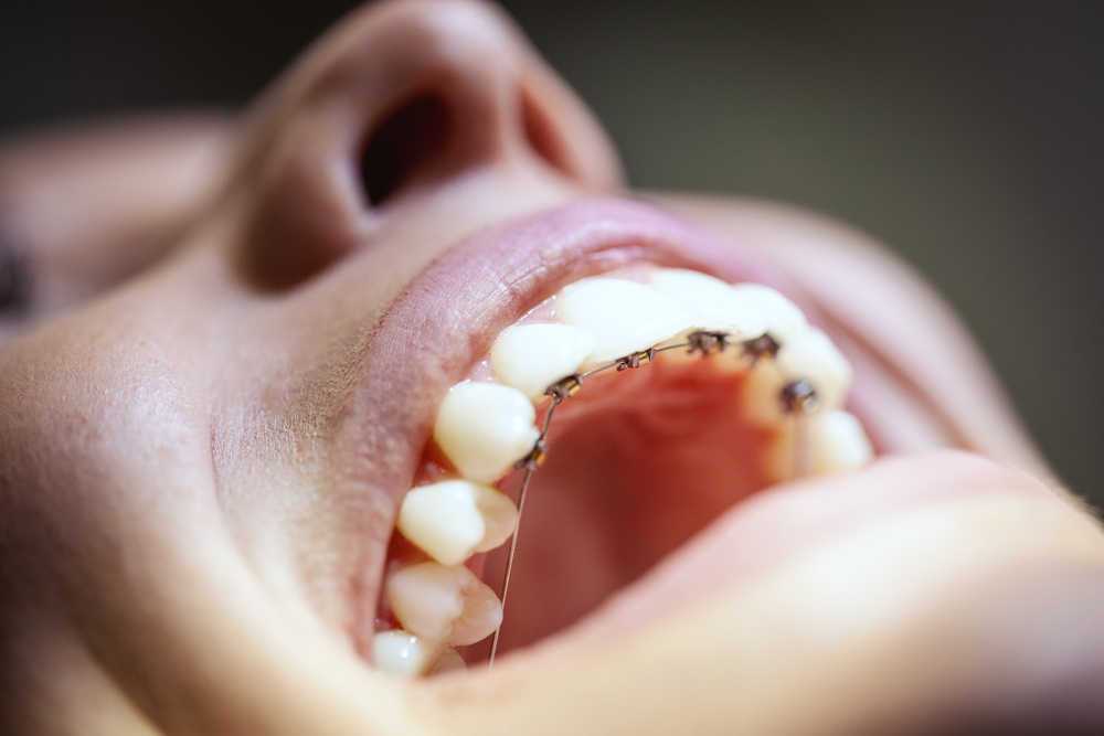 Lingual Ortodonti de Dişler Arası Bölgede Yapılan Aşındırma