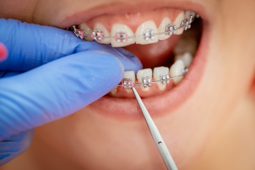 20 Yaş Dişleri ve Ortodontik Tedavi