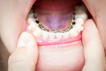 Gizli Diş Teli Tedavisi