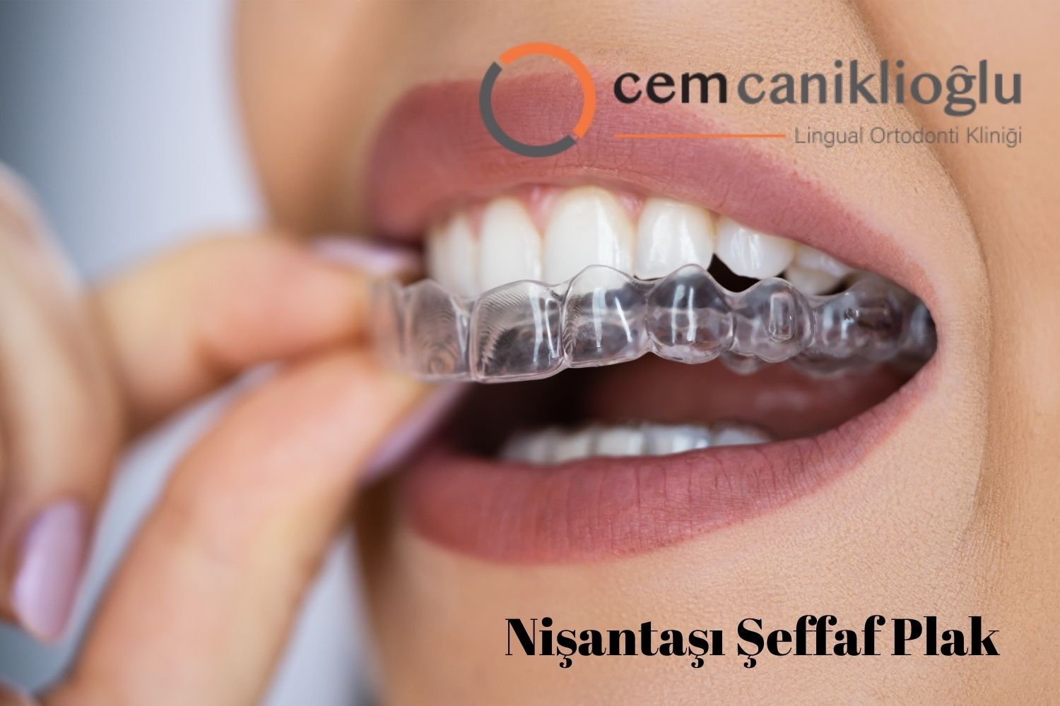 Nişantaşı Şeffaf Plak Tedavisi