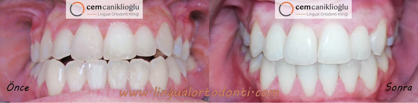 lingual ortodonti ve ortognatik cerrahi 